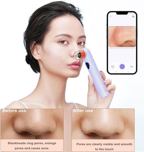 Blackhead Remover Vacuum,Blackhead Remover Tool with HD Camera & USB Charging - Pimple Extractor Vacuum,3 Stops & 4 Suction Heads Pore Extractor (Purple)