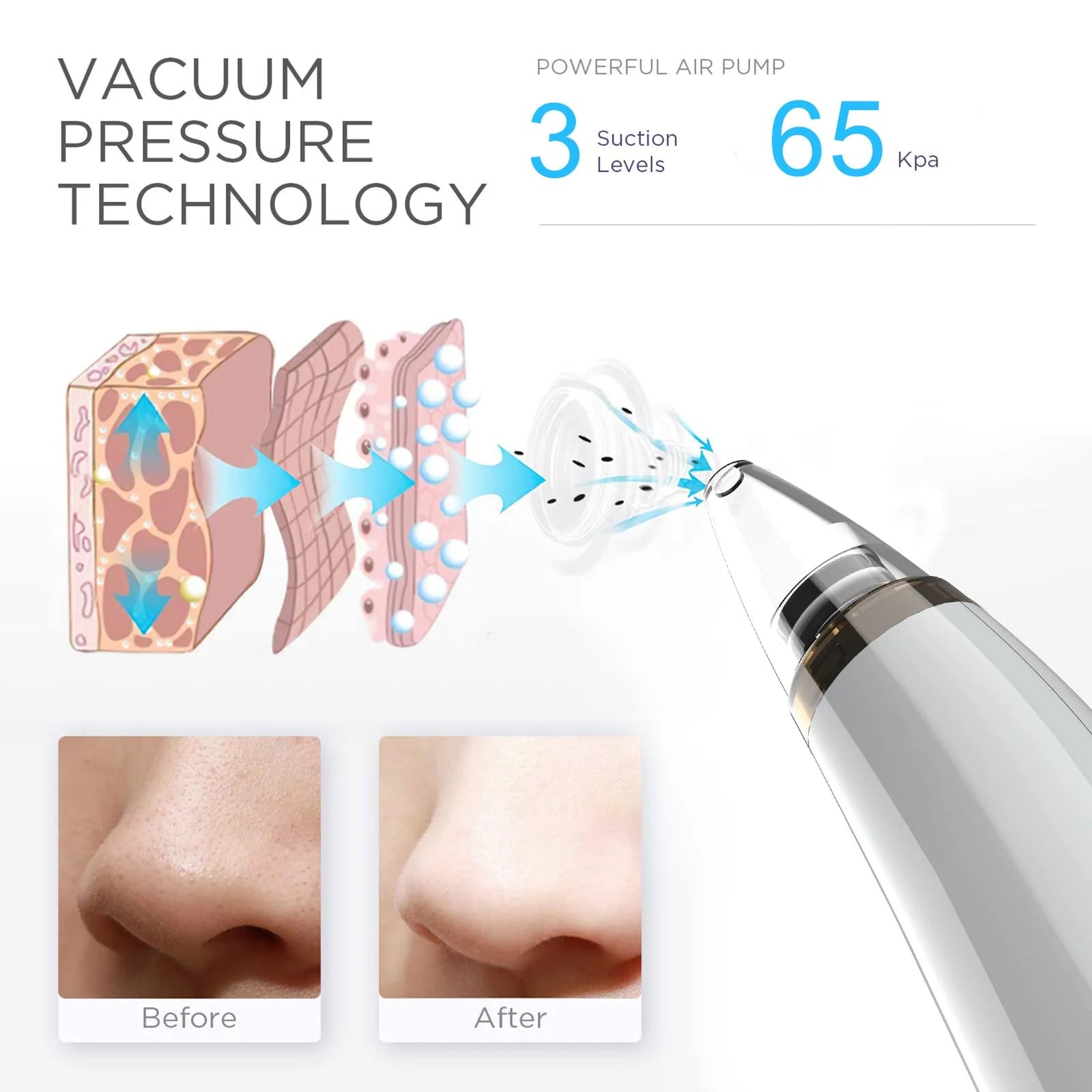 Blackhead Remover Pore Vacuum Cleaner - Electric USB Extractor with 5 Probes - White