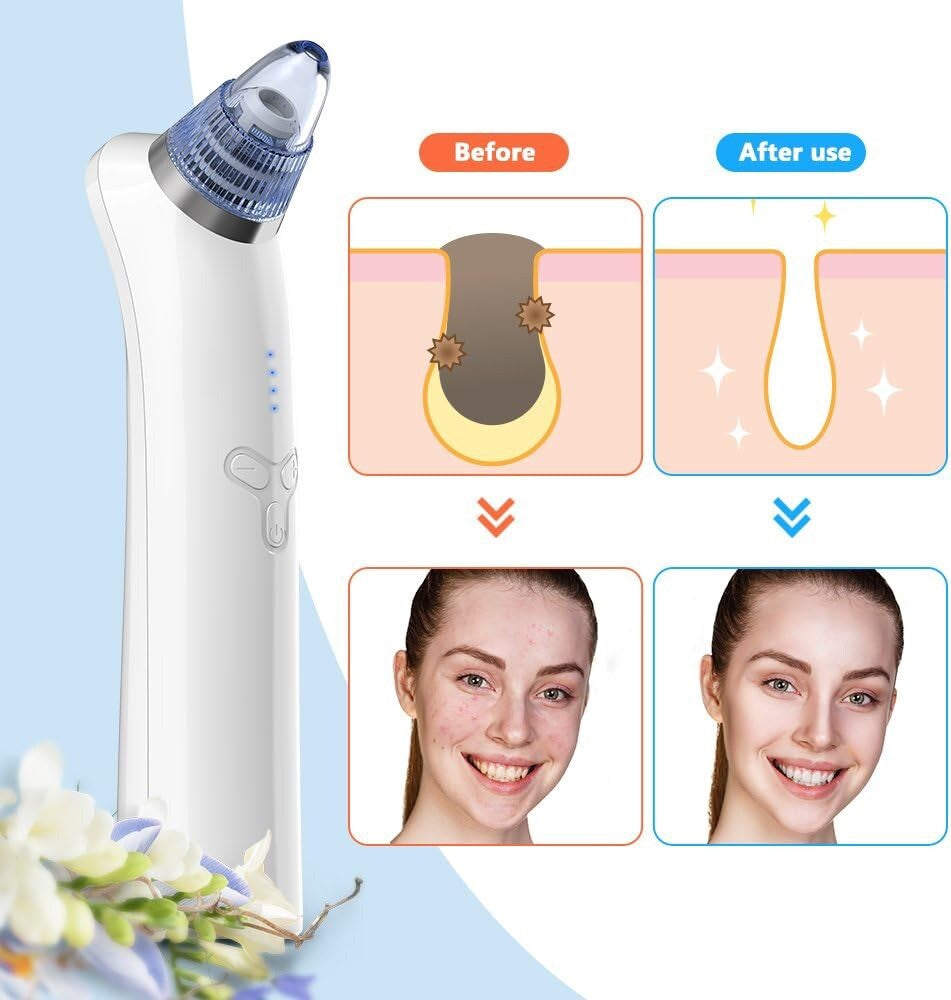 Brand New--Coofo Blackhead Remover Pore Vacuum Acne Whitehead Cleanser