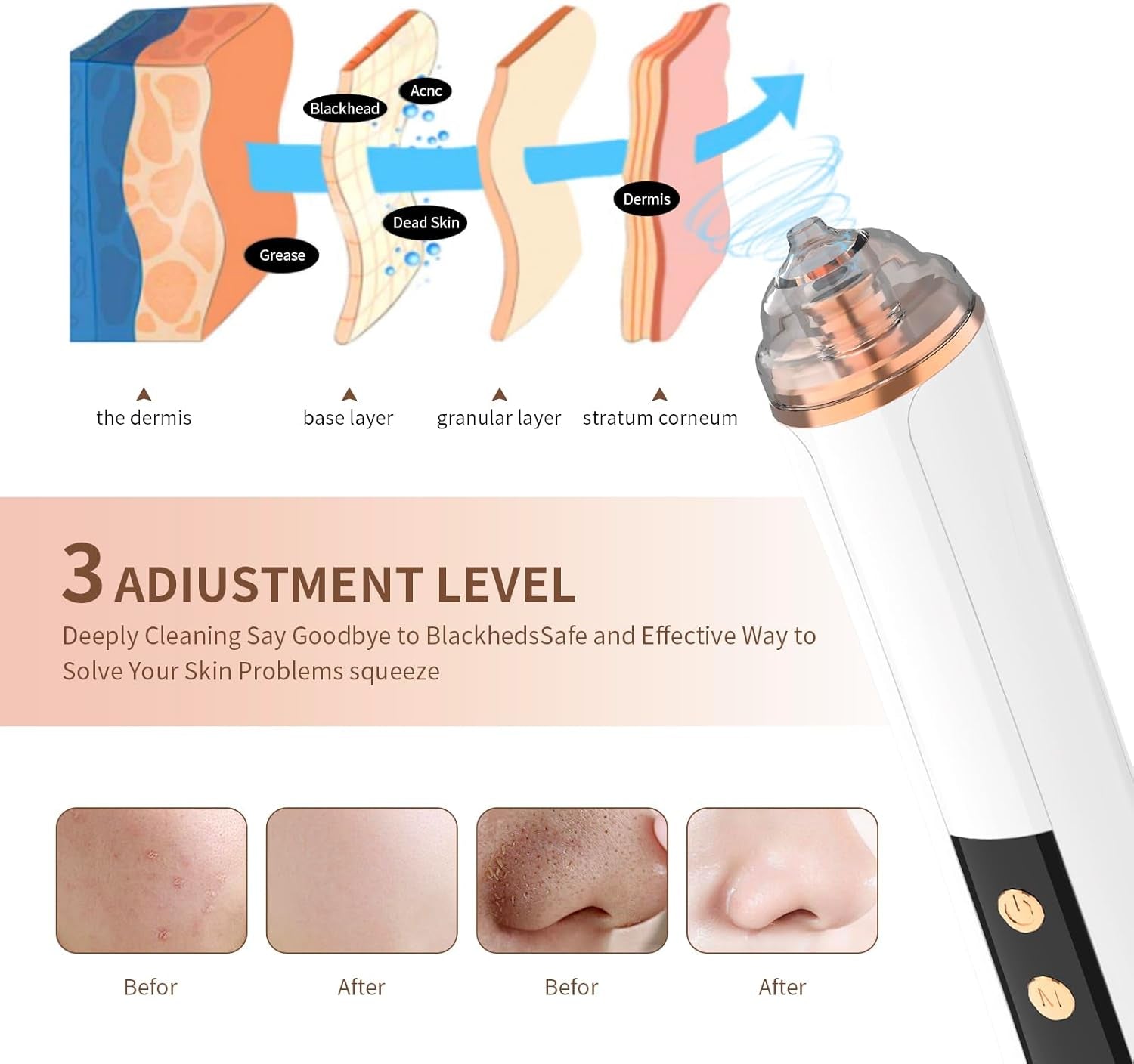 Blackhead Remover Pore Vacuum,Facial Pore Cleaner-6 Suction Power,3 Adjustable Suction Levels,Usb Rechargeable Blackhead Vacuum Kit Electric Acne Extractor Tool for Women & Men (White)