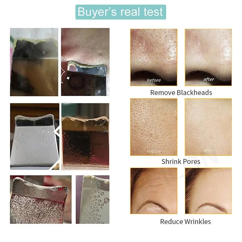 【DURABLE 】Ultrasonic Ance Pore Cleaner Shovel Cleanser Ultrasonic Skin Scrubber Peeling Blackhead Remover Deep Face Cleaning
